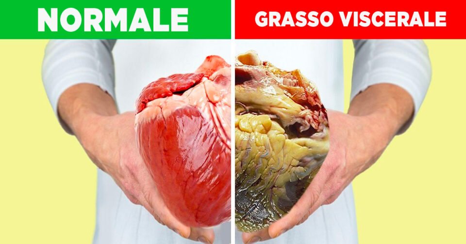 Steatosi Epatica: cosa è il fegato grasso e cosa lo provoca? 3 tofi